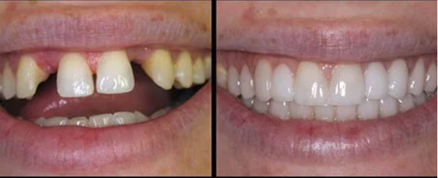 teeth with and without a dental bridge