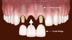 teeth with a 3 unit bridge