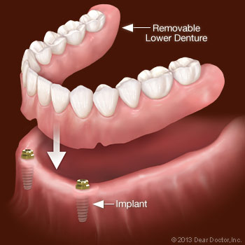 diagram of a removable lower denture