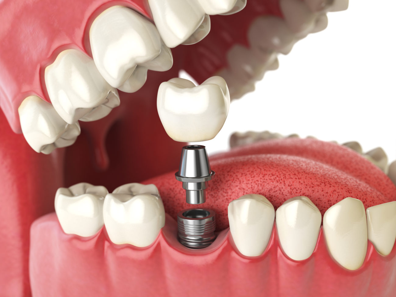 mouth with a single tooth implant