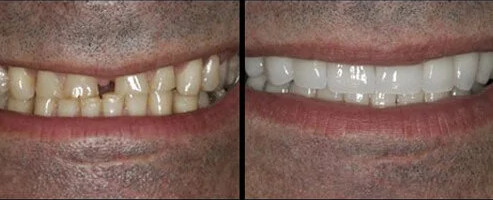 teeth with and without a veneer