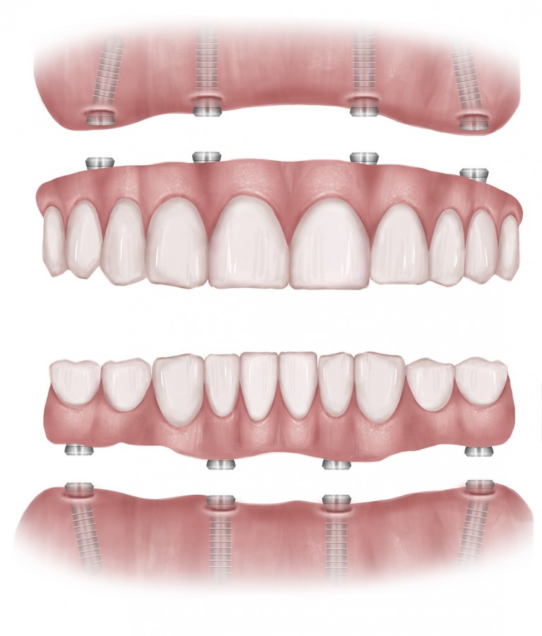 diagram of all-on-4 implant