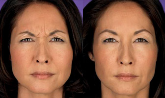 Botox Before and After