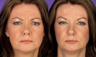 Botox Before and After