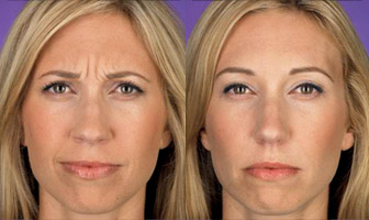 Botox Before and After